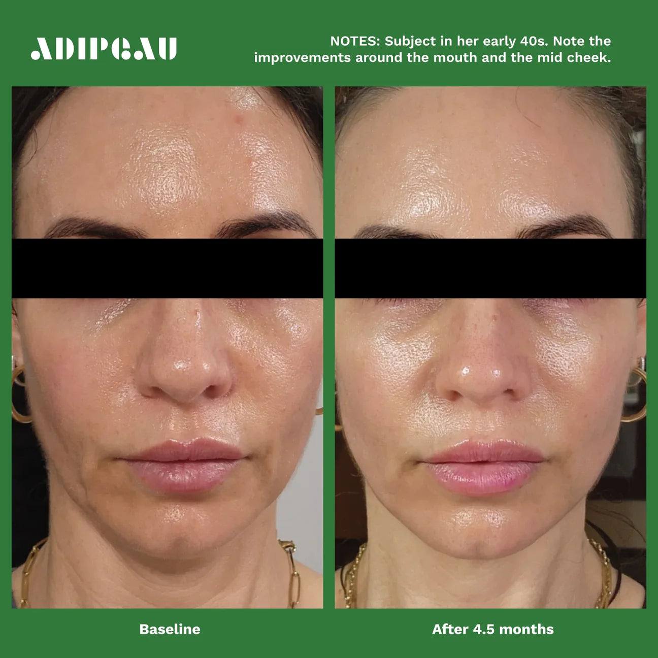 ADIPEAU Volume Cream